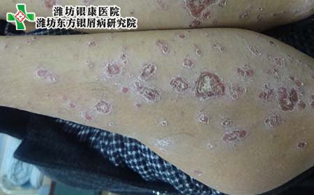 银屑病症状,得银屑病什么症状