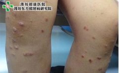 牛皮癣初期该如何控制