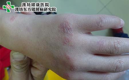 银屑病关节炎症状,银屑病关节炎表现