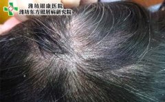 头部牛皮癣的治疗方法是什么