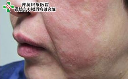 银屑病症状,面部银屑病症状