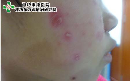 银屑病病因,面部得银屑病的原因