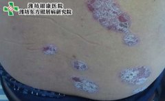 男性患银屑病的症状是什么