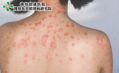 儿童长了牛皮癣怎么治疗