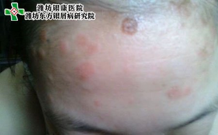 银屑病病因,银屑病传染吗