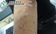 有牛皮癣表现什么症状
