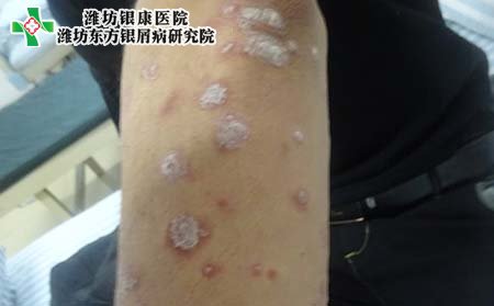 牛皮癣症状,牛皮癣有什么症状