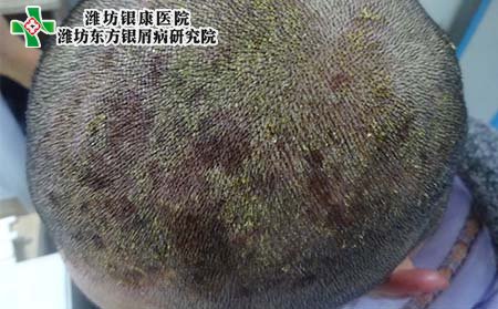 牛皮癣症状,头部牛皮癣症状