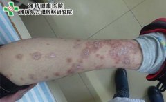 引起银屑病的病因有哪些