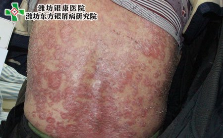 牛皮癣症状,红皮型牛皮癣症状