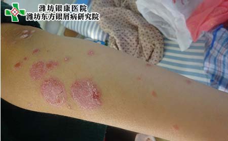 得牛皮癣原因,人为什么会得牛皮癣