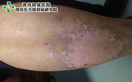 银屑病症状,银屑病症状图片