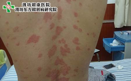 银屑病症状,银屑病有什么表现