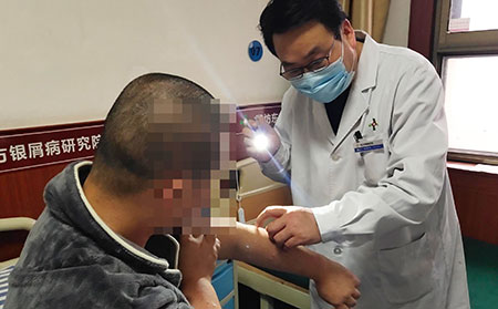 哪家医院治疗银屑病好
