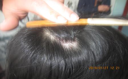 红皮型牛皮癣怎样护理-请听临沂牛皮癣医院医生说法