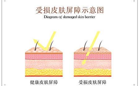 银屑病发展过程及症状表现，临沂牛皮癣医生告诉你