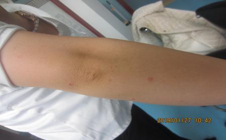 临沂银屑病饮食上哪些食物多吃好