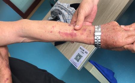 治疗银屑病需要多少钱？