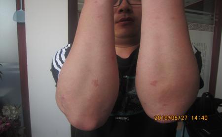 临沂治疗银屑病去哪里好