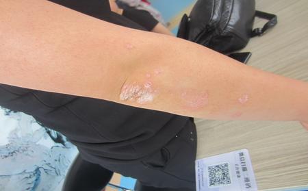 银屑病用什么药物治疗比较好，临沂专家告诉你