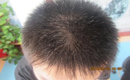引起牛皮癣的病因有哪些