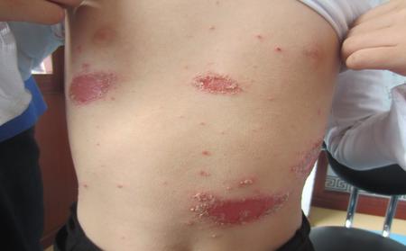 临沂银屑病医院该如何选择