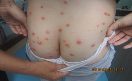 小心泛临沂银屑病危害，早治疗为妙