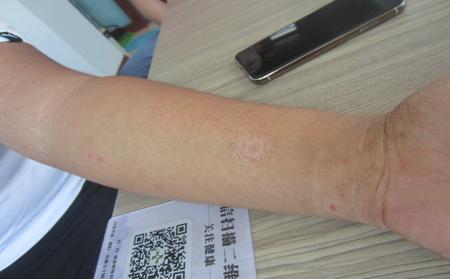 临沂治疗银屑病好医院怎么判断