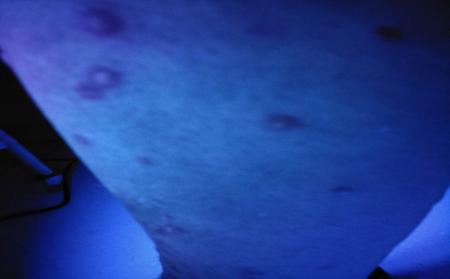 临沂牛皮癣医院哪家好,牛皮癣患者饮食