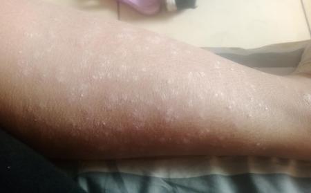 银屑病刚开始长的图片是什么样