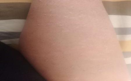 临沂治疗银屑病医院哪家好