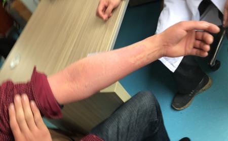 临沂治疗牛皮癣专科医院哪里好