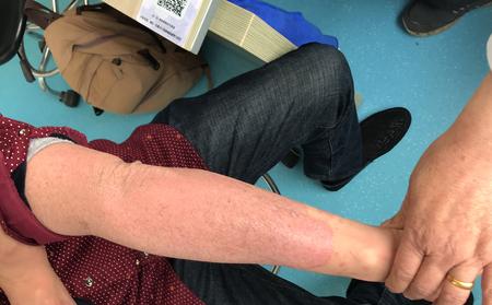 临沂银屑病医院告诉你牛皮癣的前期表现是什么