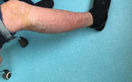 银屑病患者出现心理问题该怎么办