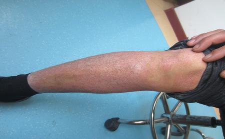 临沂牛皮癣发病之前有哪些特点